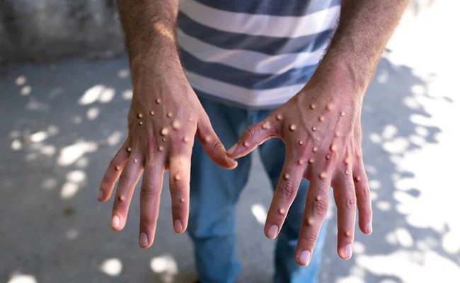 Mpox को लेकर सरकार अलर्ट, इस एयरपोर्ट पर होगी स्क्रीनिंग