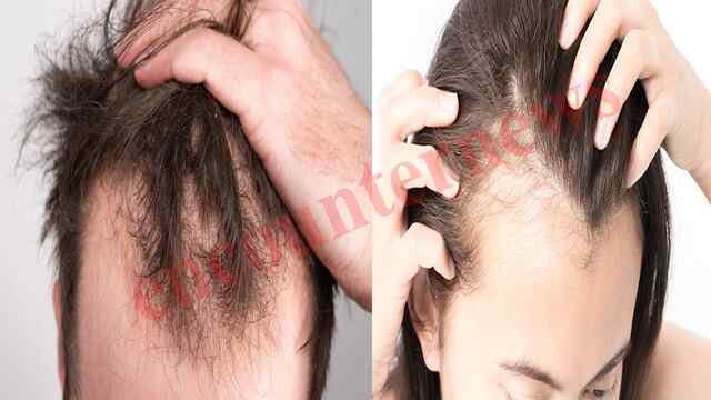 क्यों झड़ते हैं बाल? गंजेपन से जुड़ी जरूरी बातें और समाधान