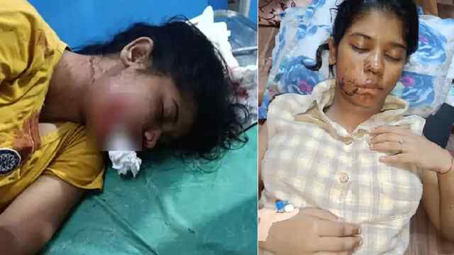 BBA Student को कुत्तों ने बनाया शिकार, मुंह को बुरी तरह नोचा, 17 टांके लगे
