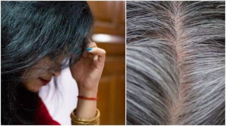 Health News : 18 की उम्र में ही बालों में दिखने लगी है सफेदी, ये नियम करें फालो नहीं पकेंगे बाल