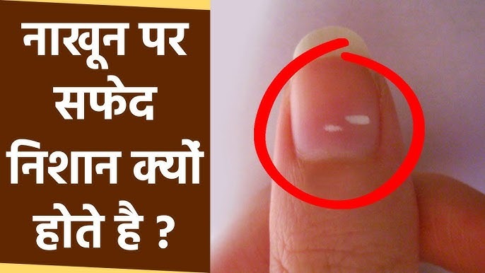 नाखूनों पर सफेद धब्बे क्यों पड़ते हैं? जानिए इसके पीछे के कारण