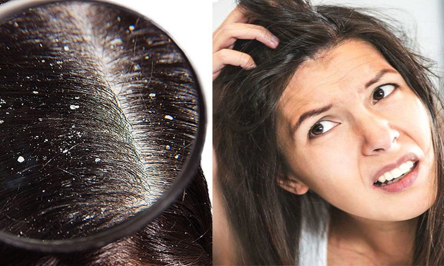 क्या आप भी परेशान है बढ़ते Dandruff से, तो अपनाएं ये घरेलू नुस्खे