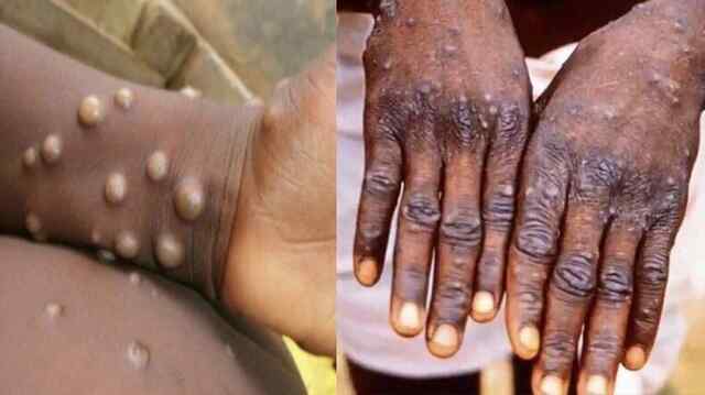 दुनियाभर में पैर पसार रहा Monkey Pox, नई गाइडलाइन जारी