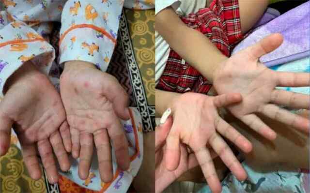 पंजाबः Monkeypox केस को लेकर लोगों में भय का माहौल 