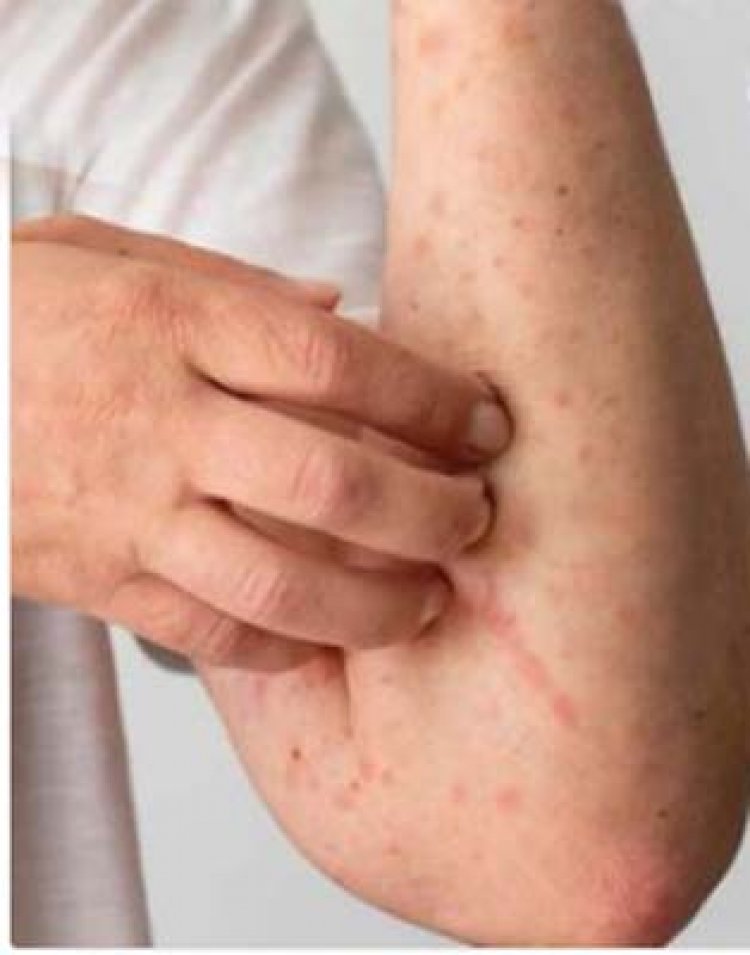 टेंडर हार्ट स्कूल में LKG के बच्चे में मिले HFMD के लक्षण