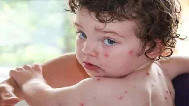छोटे बच्चों में बढ़ा Tomato Flu का खतरा, स्वास्थ्य मंत्रालय ने जारी की गाइडलाइन
