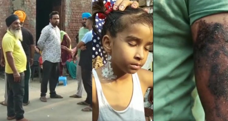 पंजाबः 20 रुपए मांगने पर समोसे वाले ने बच्ची सहित 6 लोगों पर डाला गर्म तेल