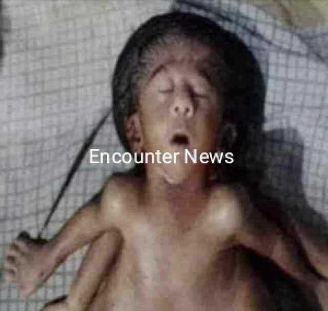 4 हाथ-4 पैर, 2 दिल वाली विचित्र बच्ची का जन्म