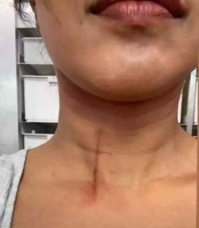 Shooting के दौरान चोटिल हुईं Actress, गले पर लगा गहरा कट