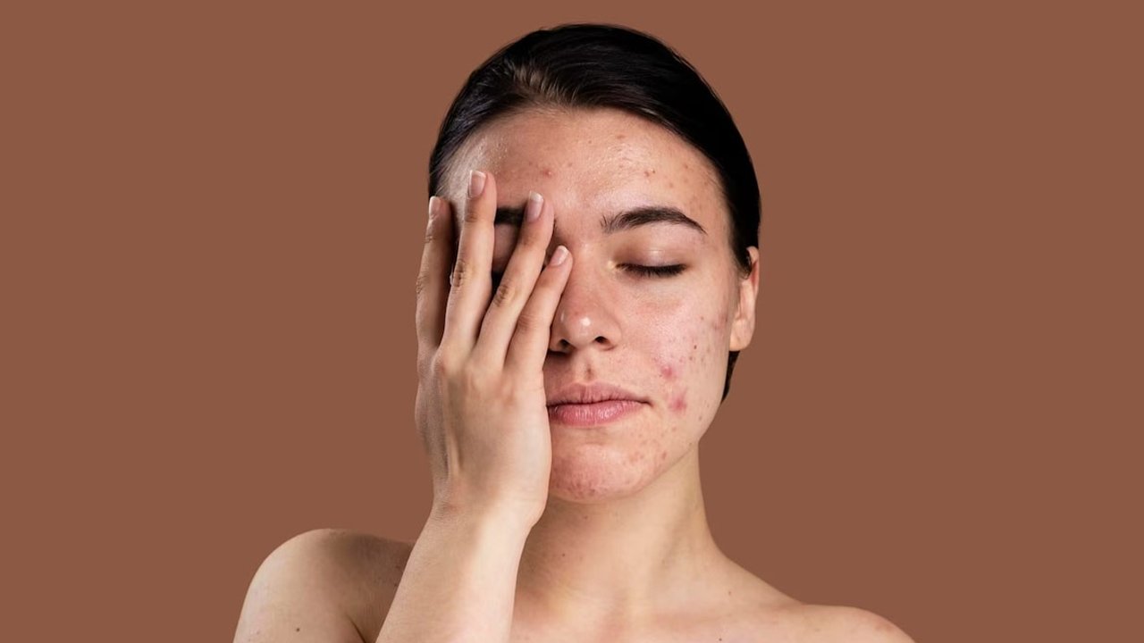 चेहरे पर दाग-धब्बों से परेशान है तो इस्तेमाल करें ये घरेलू नुस्खे