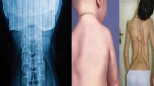 इस इलाके में Stone Man Syndrome ने दी दस्तक, पत्थर बन रहा 9 साल का बच्चा
